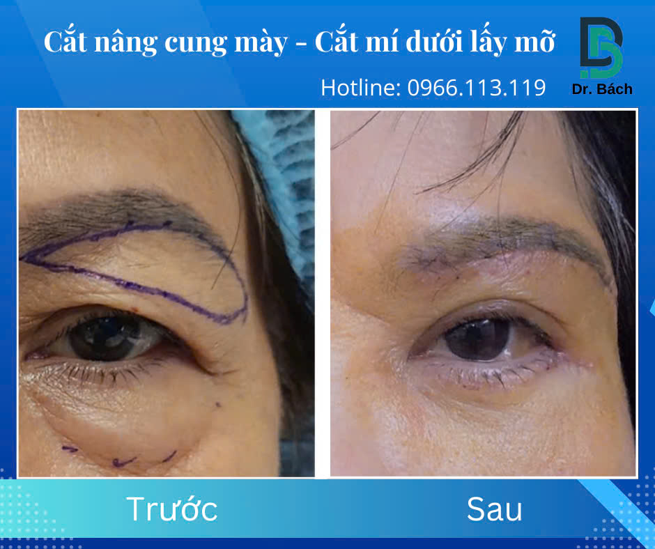Nâng cung mày